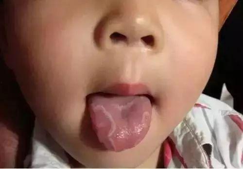 小舌头掉下来的图片,揭秘口腔健康小常识