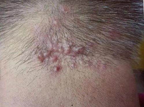 腿部毛囊炎图片,症状、成因及防治策略解析
