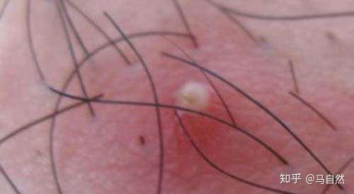 腿部毛囊炎图片,症状、成因及防治策略解析