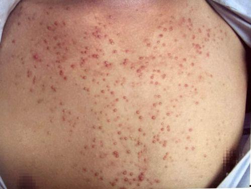 腿部毛囊炎图片,症状、成因及防治策略解析