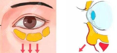 眼袋图片大全,揭秘眼部肌肤问题与解决方案
